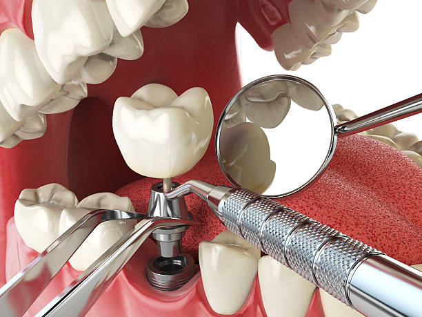 Best Emergency Root Canal Treatment in Porter, IN